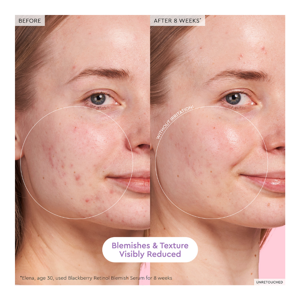 Blackberry Retinol Blemish Serum
