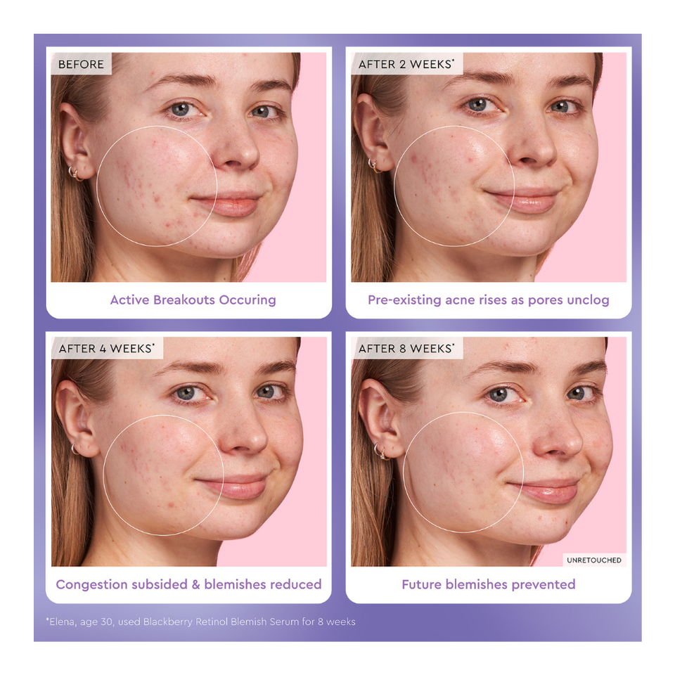 Blackberry Retinol Blemish Serum