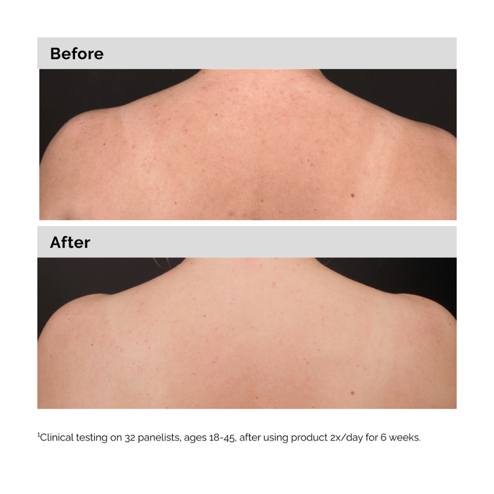 Salicylic Acid 0.5% Body Serum